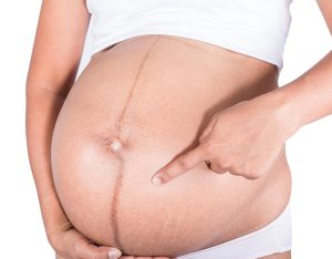 Dark Line on Pregnant women Belly 

