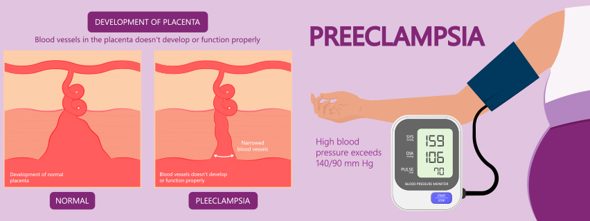 What is preeclampsia in pregnancy and how does it affect pregnant women?